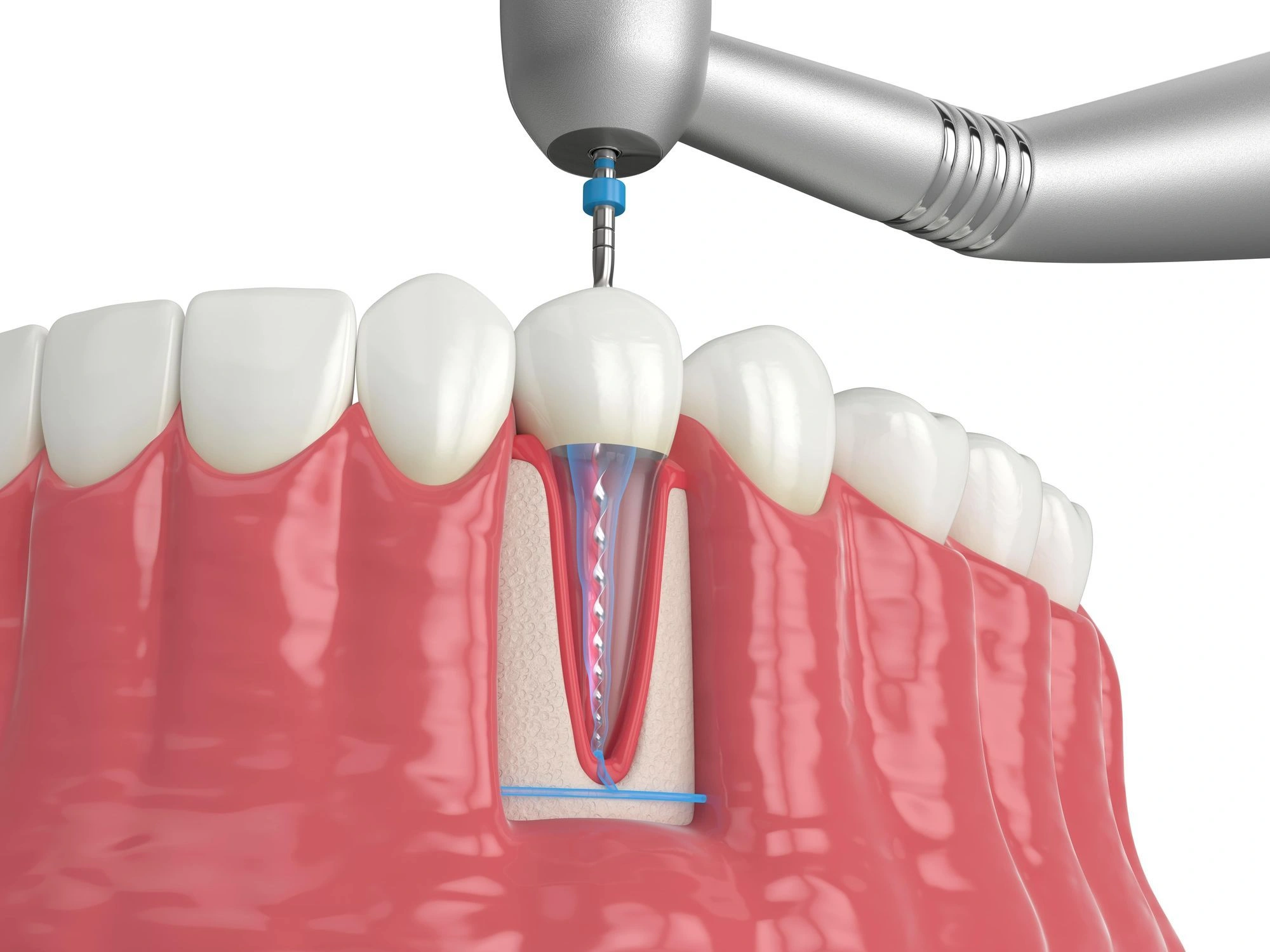 Laser Root Canal Therapy