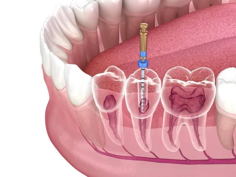 Laser Root Canal Therapy