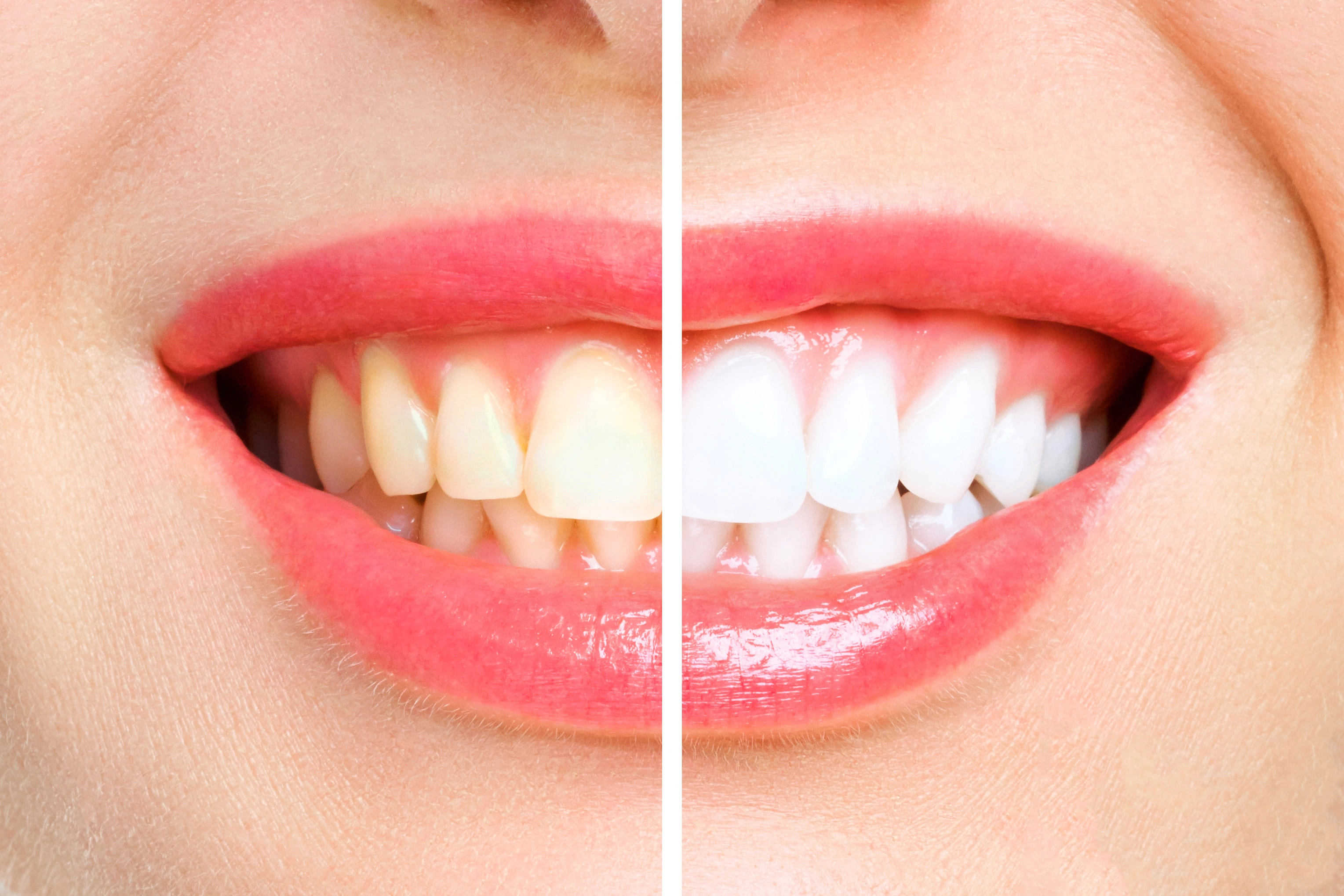Teeth Whitening Manjeri