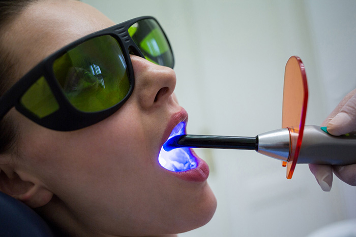 Laser Cavity Removal & Fillings